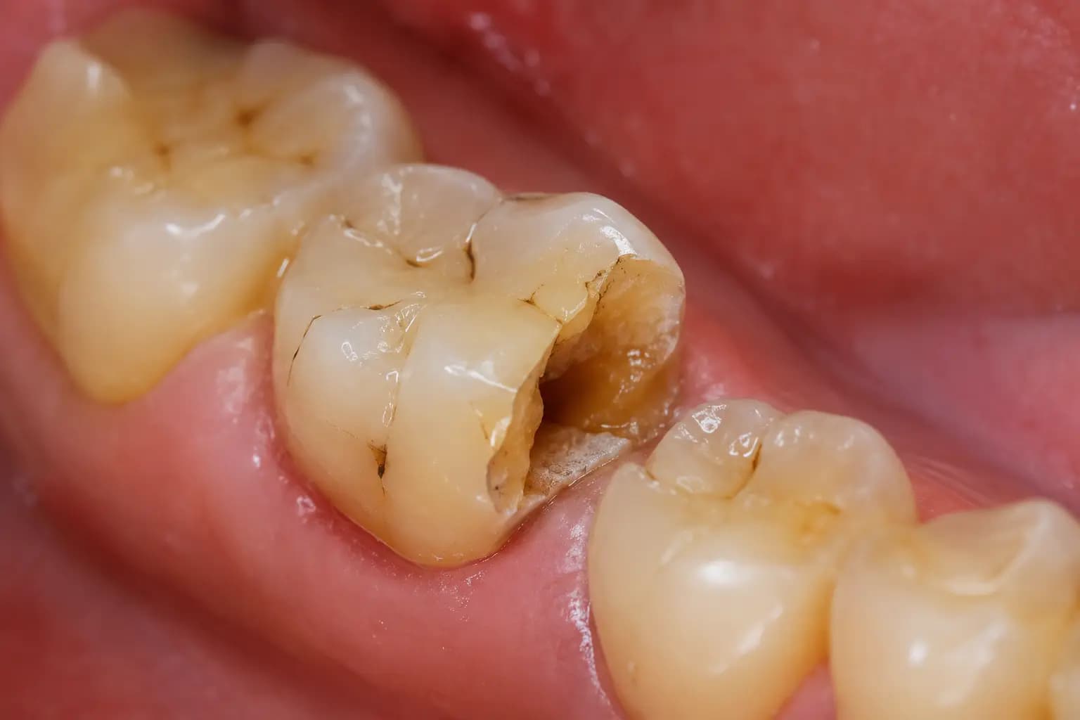 Tooth fractures while eating hard foods