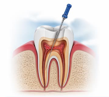 Infected pulp inside the root canals