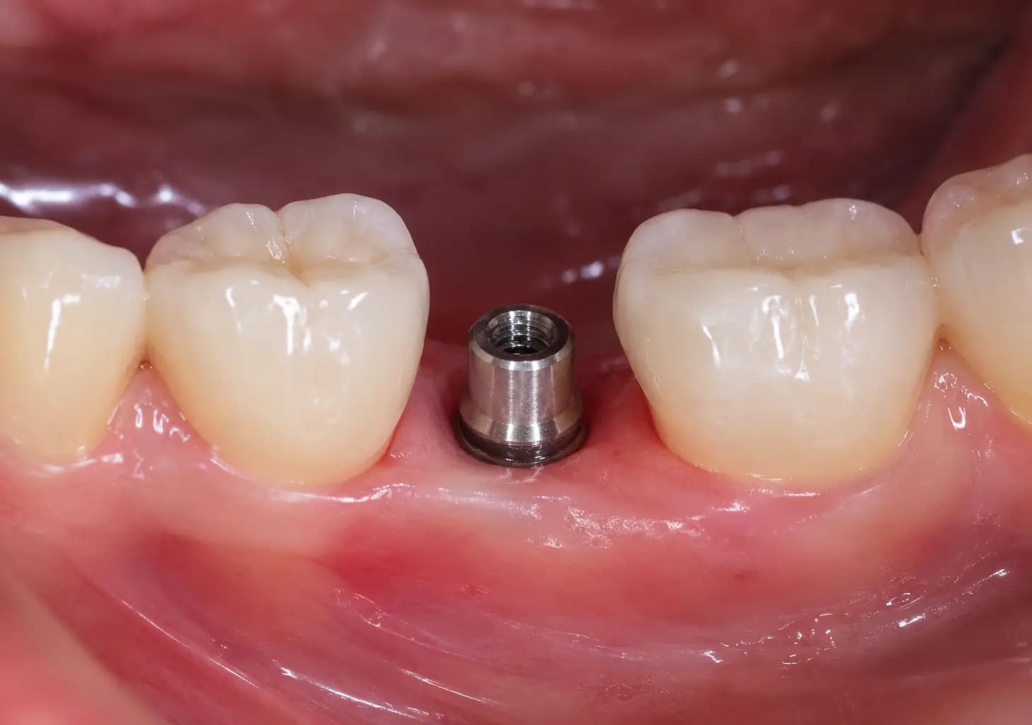 teeth implant