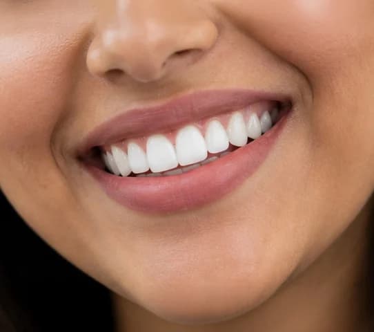 women with veneers
